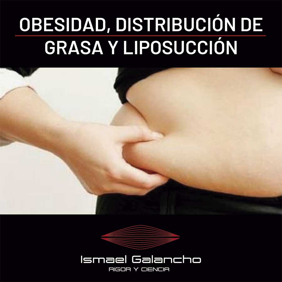 Obesidad, distribución de grasa y liposucción