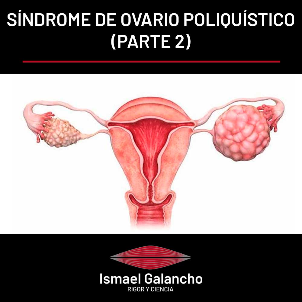 Síndrome del ovario poliquístico (Parte II)