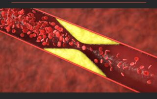 ateroesclerosis
